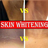 Whitening Cream Private Parts Underarm Bleaching Serum Whiten Butt Knee Brighten Inner Thigh Intimate Parts Dark Remove Melanin